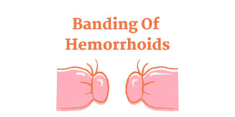 Banding Of Hemorrhoids - Heal My Hemorrhoids